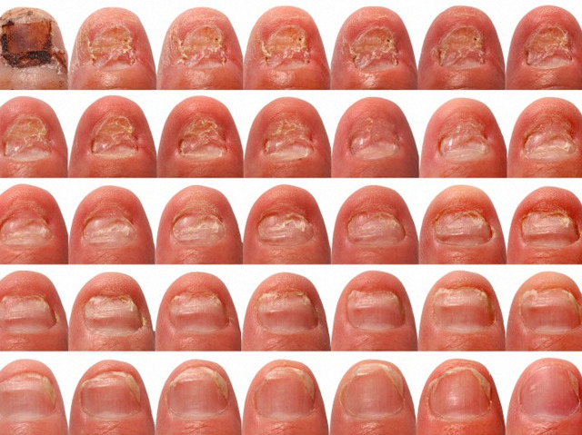 nail fold - pictures, photos